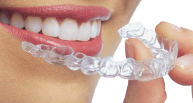 What Is Invisalign?